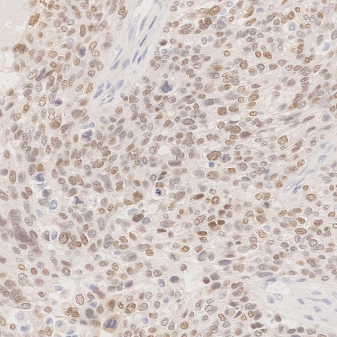 IHC staining of human ovary cancer using 60145-4-Ig