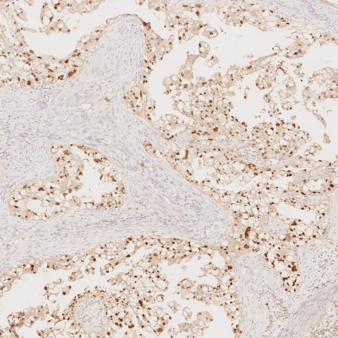 IHC staining of human ovary cancer using 60145-4-Ig