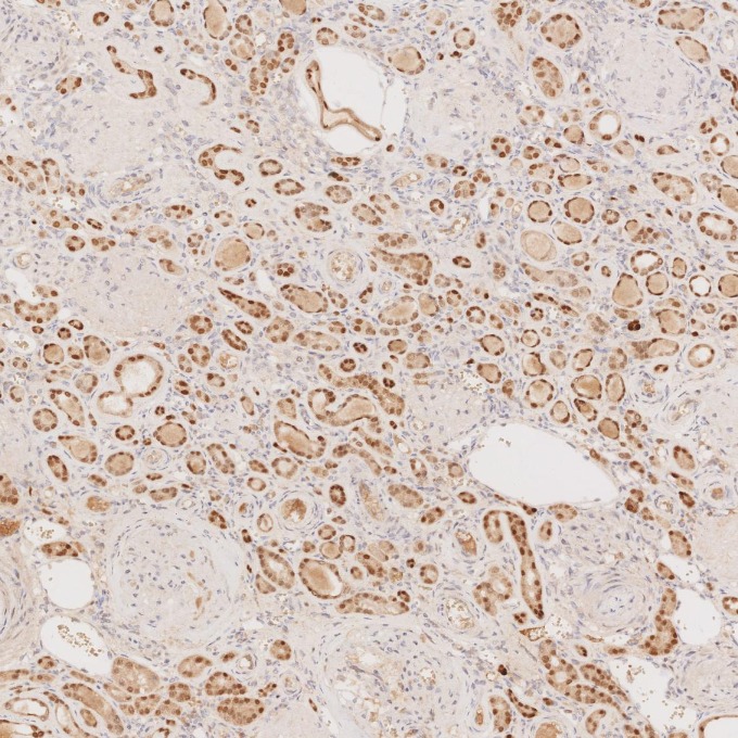 IHC staining of human renal cell carcinoma using 60145-4-Ig