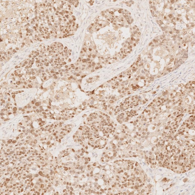 IHC staining of human ovary cancer using 60145-4-Ig