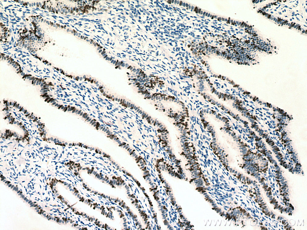 Immunohistochemical analysis of paraffin-embedded human ovary tumor tissue slide using 80022-1-RR (PAX8 antibody) at dilution of 1:5000 (under 10x lens). Heat mediated antigen retrieval with Tris-EDTA buffer (pH 9.0). IHC staining of human ovary tumor using 80022-1-RR