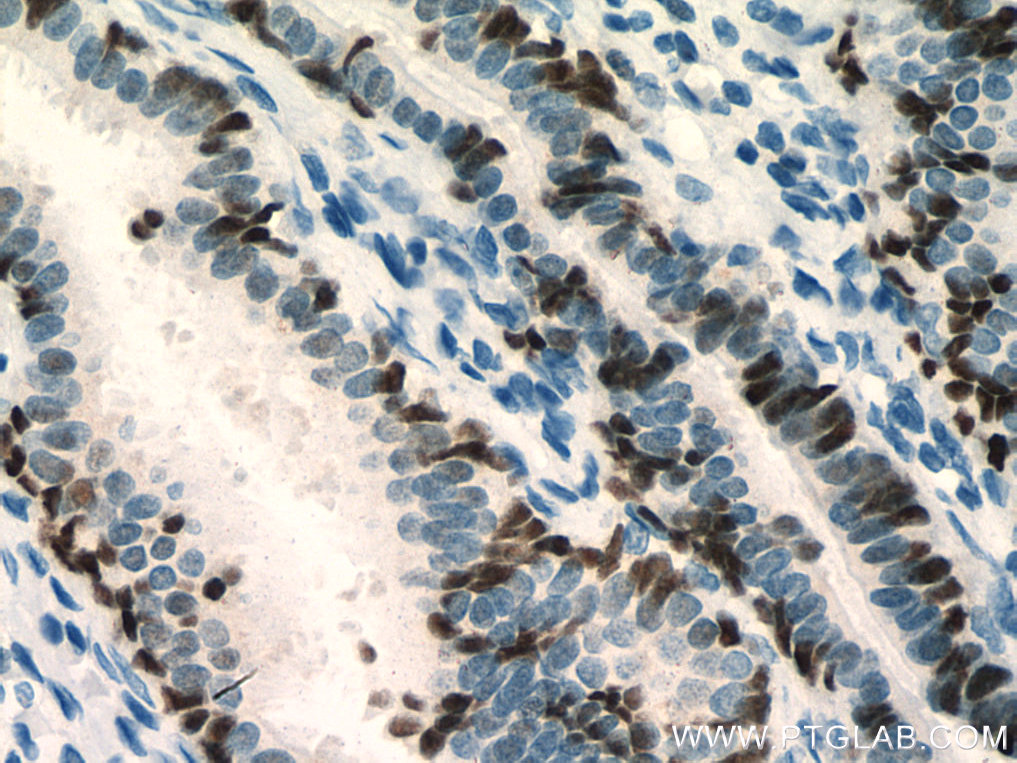 Immunohistochemical analysis of paraffin-embedded human ovary tumor tissue slide using 80022-1-RR (PAX8 antibody) at dilution of 1:5000 (under 40x lens). Heat mediated antigen retrieval with Tris-EDTA buffer (pH 9.0). IHC staining of human ovary tumor using 80022-1-RR