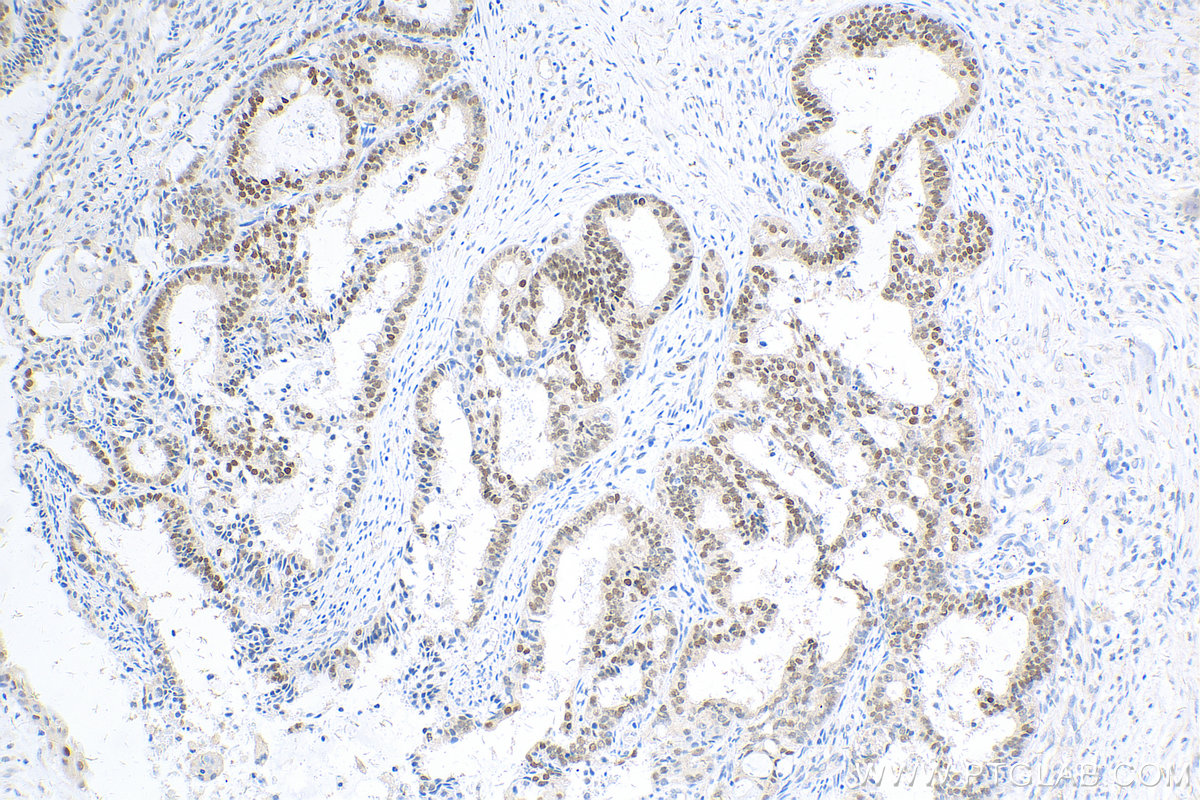 IHC staining of human ovary tumor using 80756-1-RR