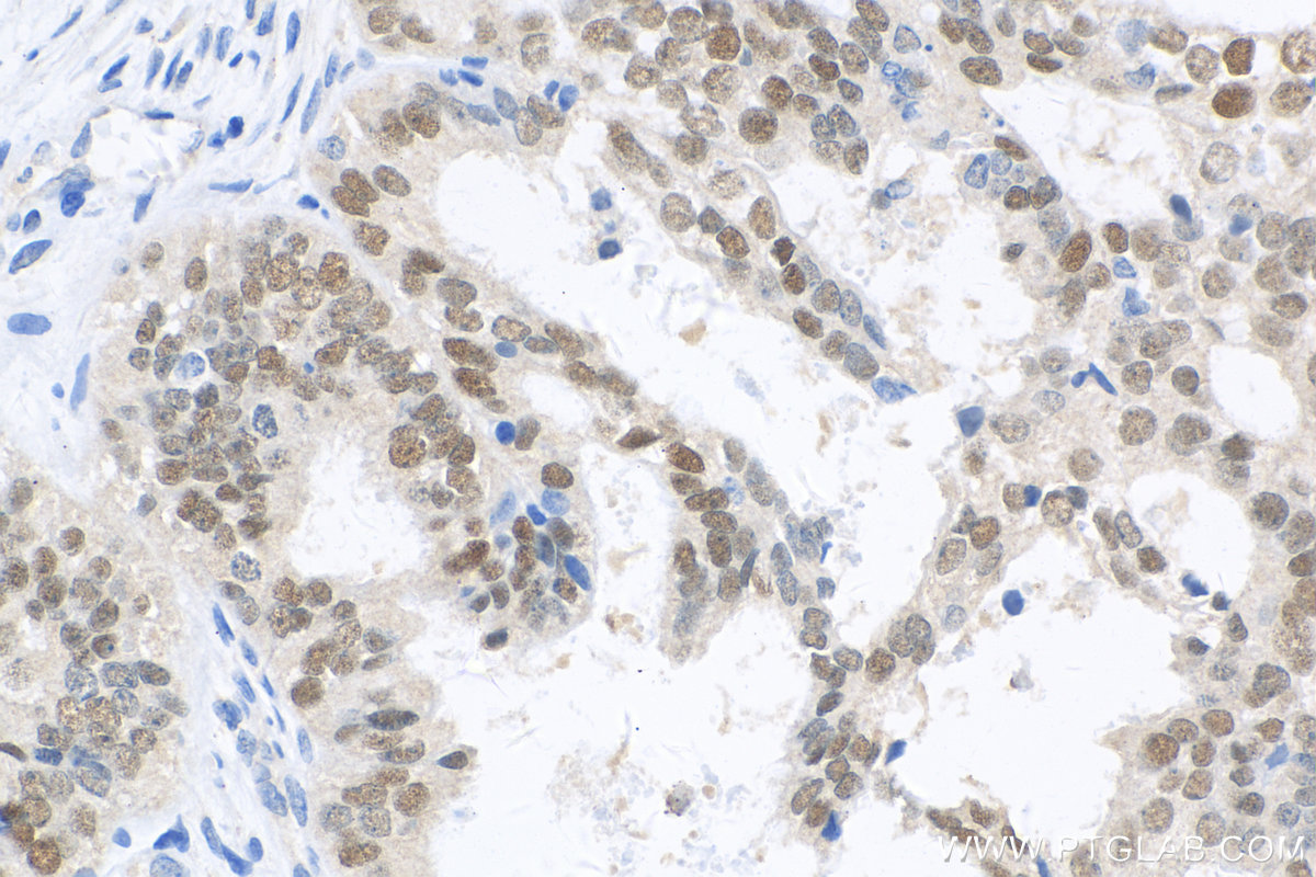 IHC staining of human ovary tumor using 80756-1-RR