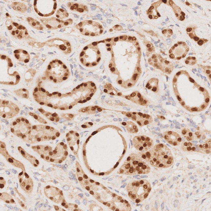 IHC staining of human renal cell carcinoma using 80756-1-RR IHC staining of human renal cell carcinoma using 80756-1-RR