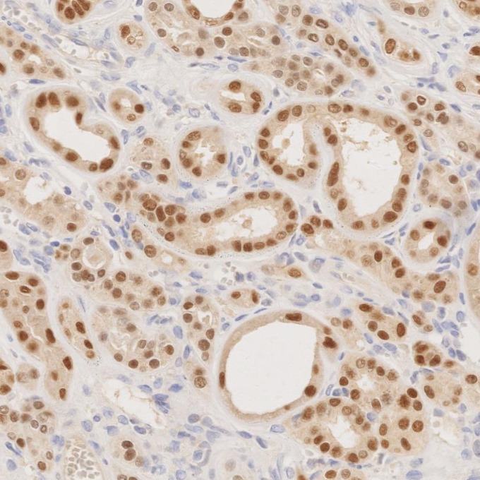IHC staining of human renal cell carcinoma using 80756-1-RR IHC staining of human renal cell carcinoma using 80756-1-RR