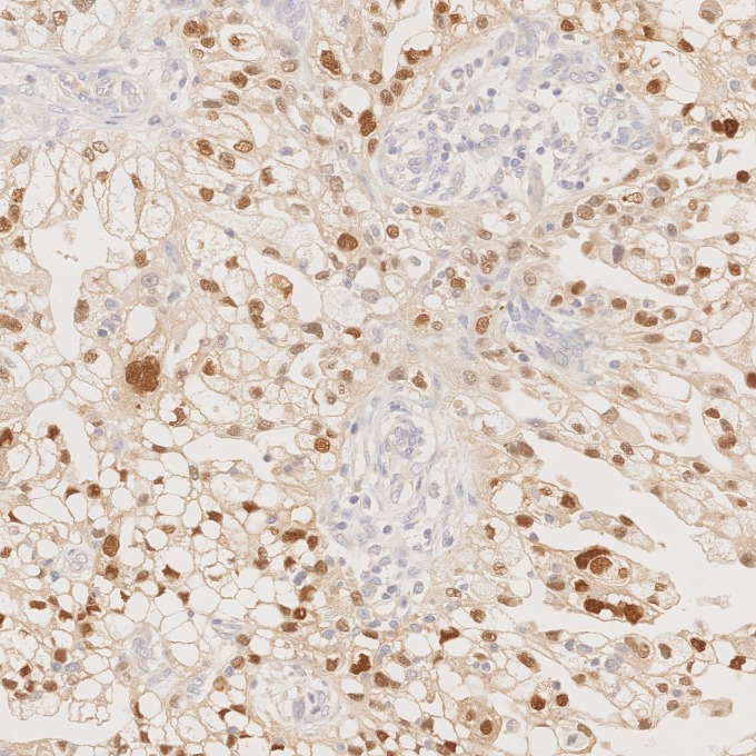 IHC staining of human ovary cancer using 80756-1-RR IHC staining of human ovary cancer using 80756-1-RR