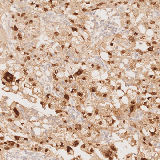 IHC staining of human ovary cancer using 80756-1-RR IHC staining of human ovary cancer using 80756-1-RR