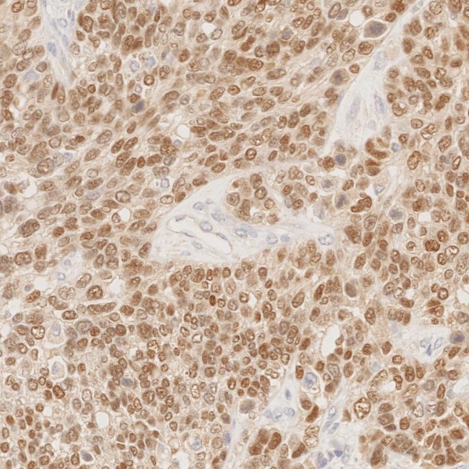IHC staining of human ovary cancer using 80756-1-RR IHC staining of human ovary cancer using 80756-1-RR
