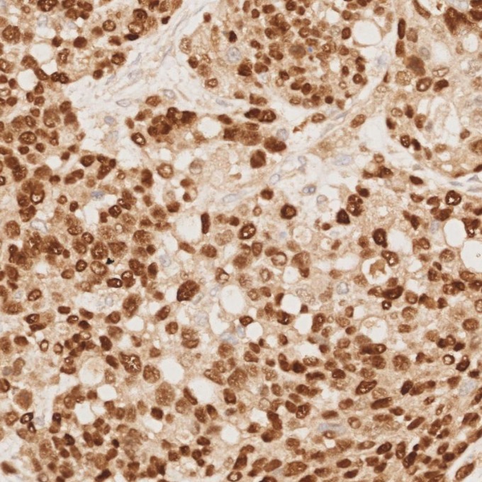 IHC staining of human ovary cancer using 80756-1-RR IHC staining of human ovary cancer using 80756-1-RR