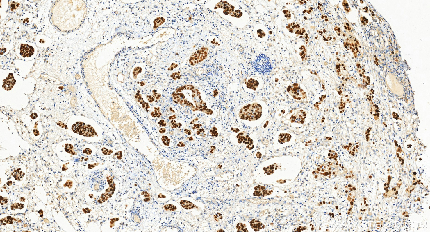 IHC staining of human ovary cancer using 80756-1-RR (same clone as 80756-1-PBS)