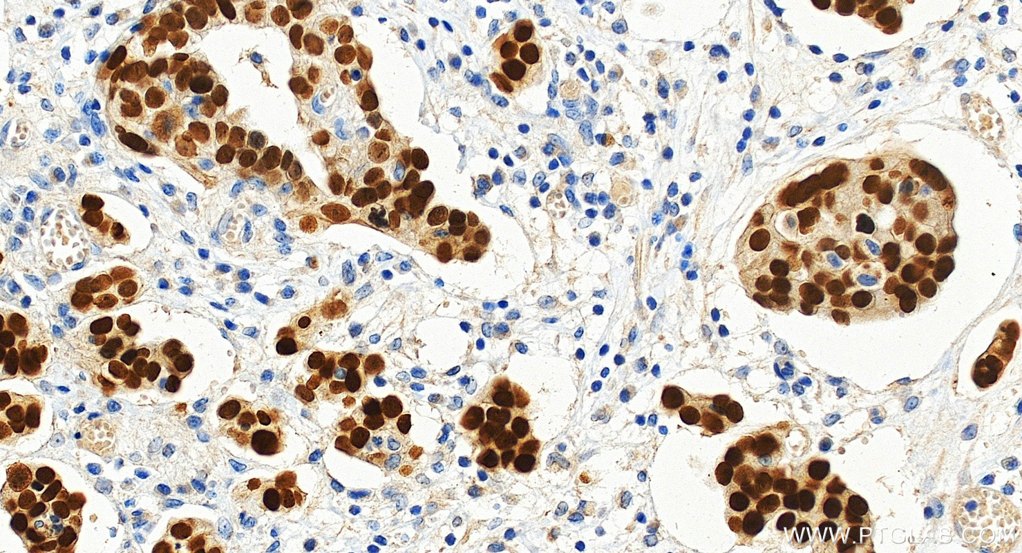 IHC staining of human ovary cancer using 80756-1-RR (same clone as 80756-1-PBS)