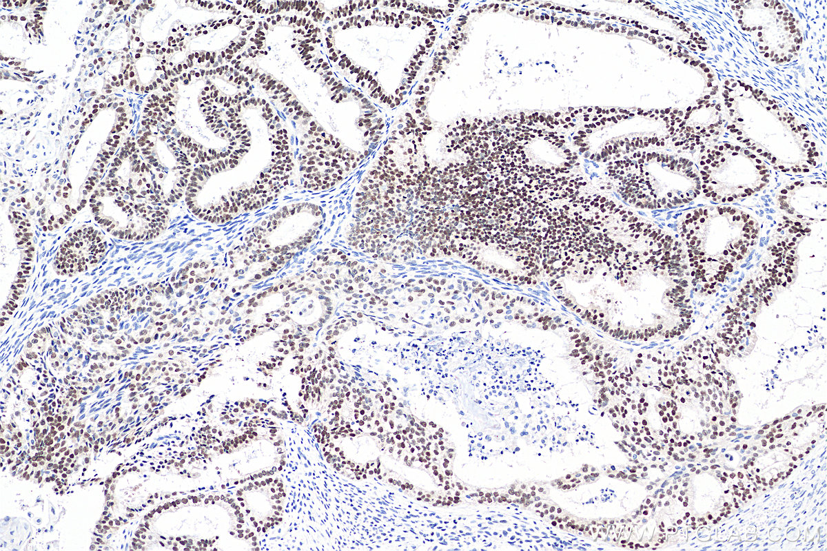 IHC staining of human ovary tumor using 81032-1-RR IHC staining of human ovary tumor using 81032-1-RR
