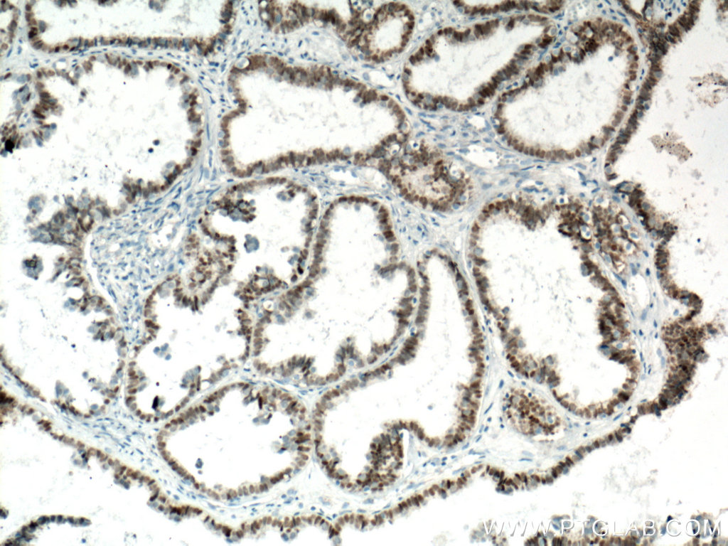 IHC staining of human ovary tumor using Biotin-60145