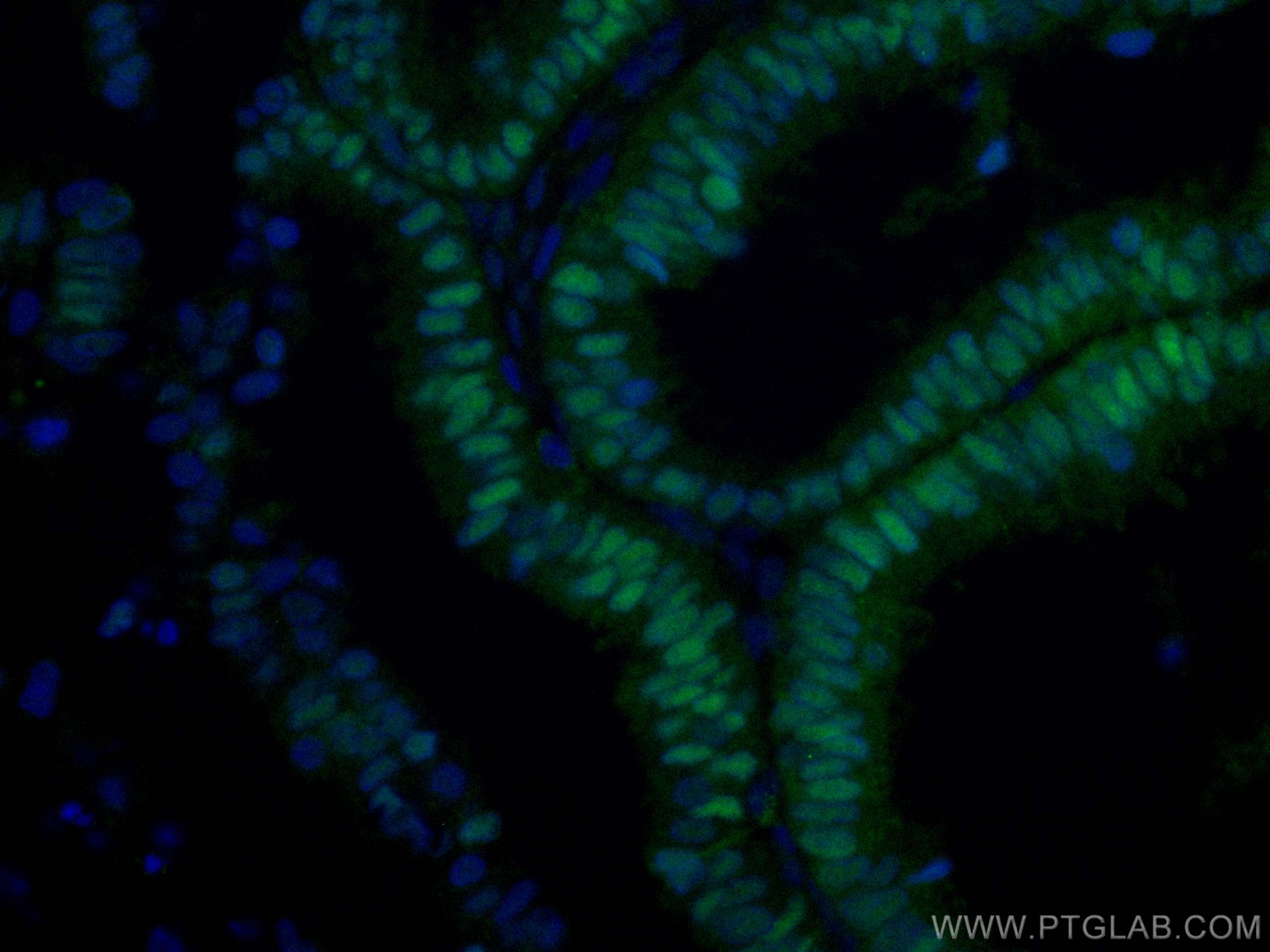 IF Staining of human ovary tumor using CL488-60145