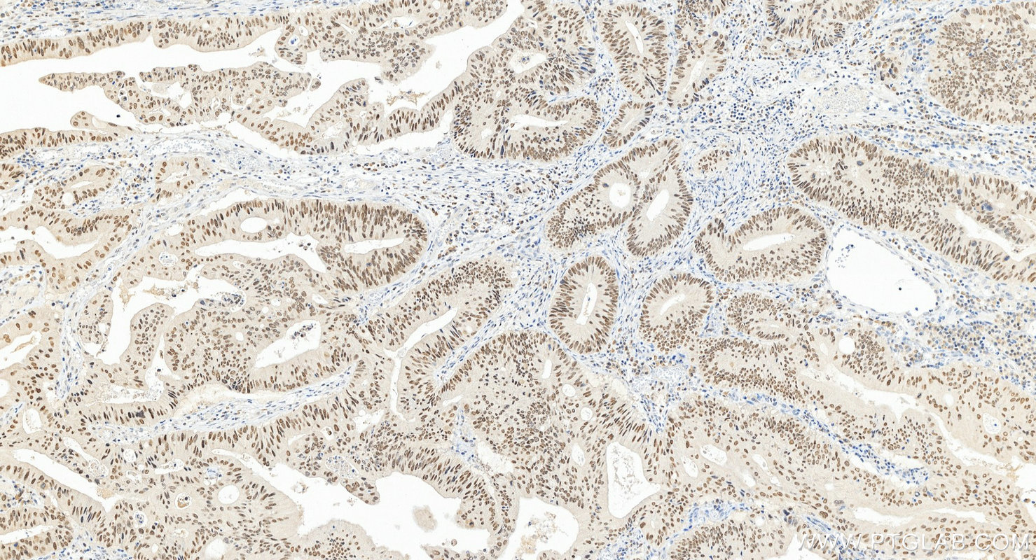 IHC staining of human colon cancer using 12563-1-AP