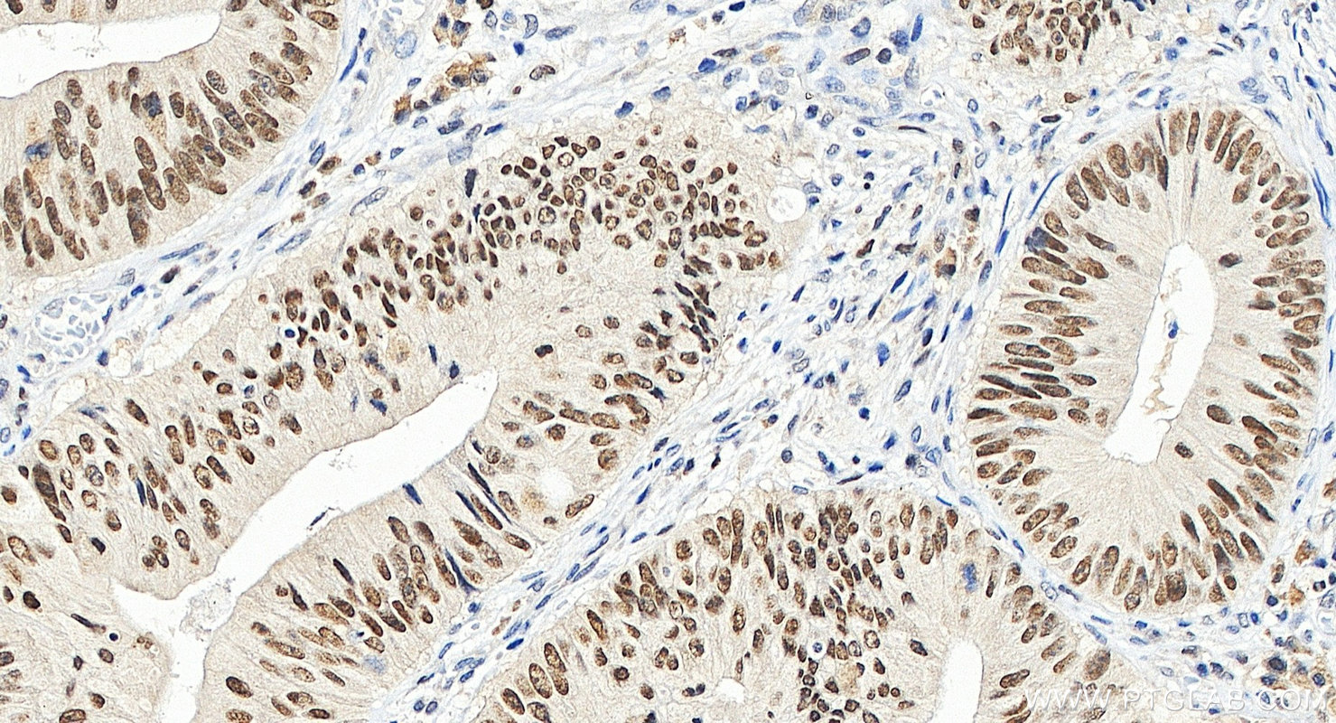 IHC staining of human colon cancer using 12563-1-AP