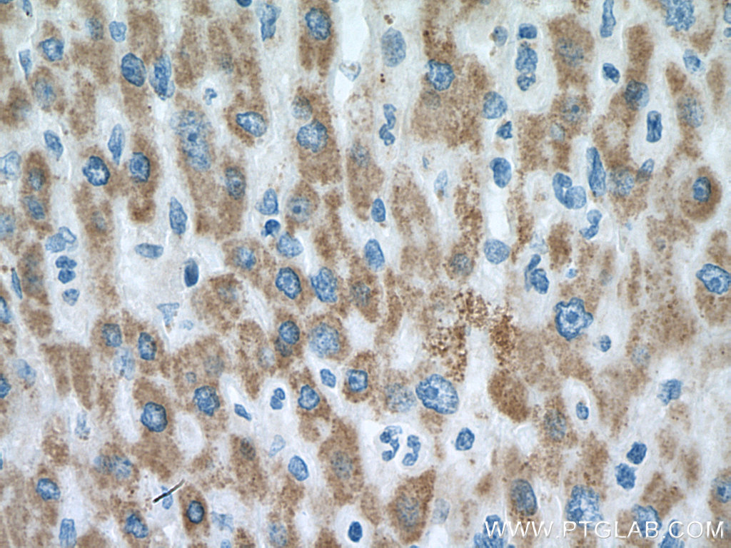 IHC staining of human liver cancer using 16588-1-AP