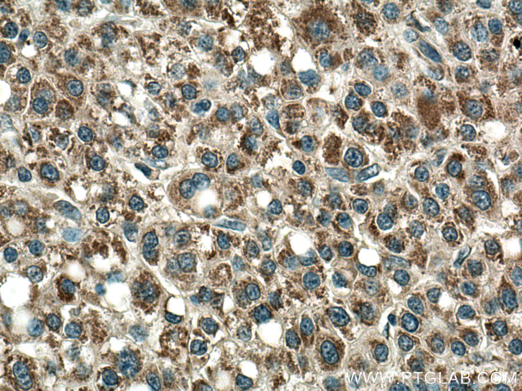 IHC staining of human liver cancer using 21988-1-AP