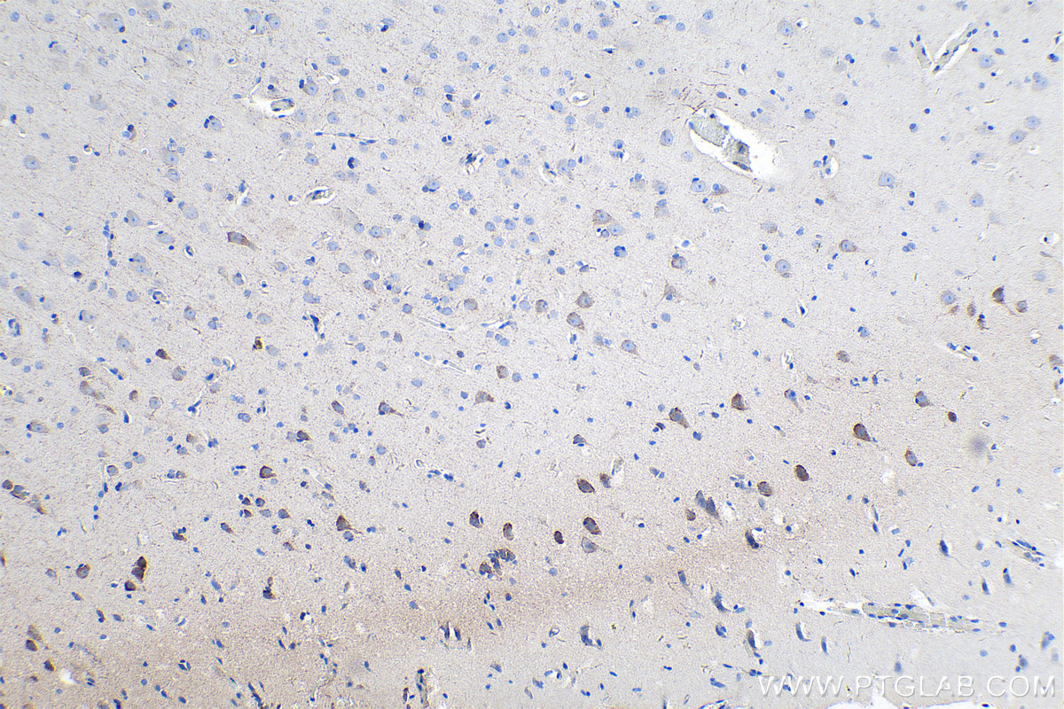 IHC staining of human gliomas using 20070-1-AP