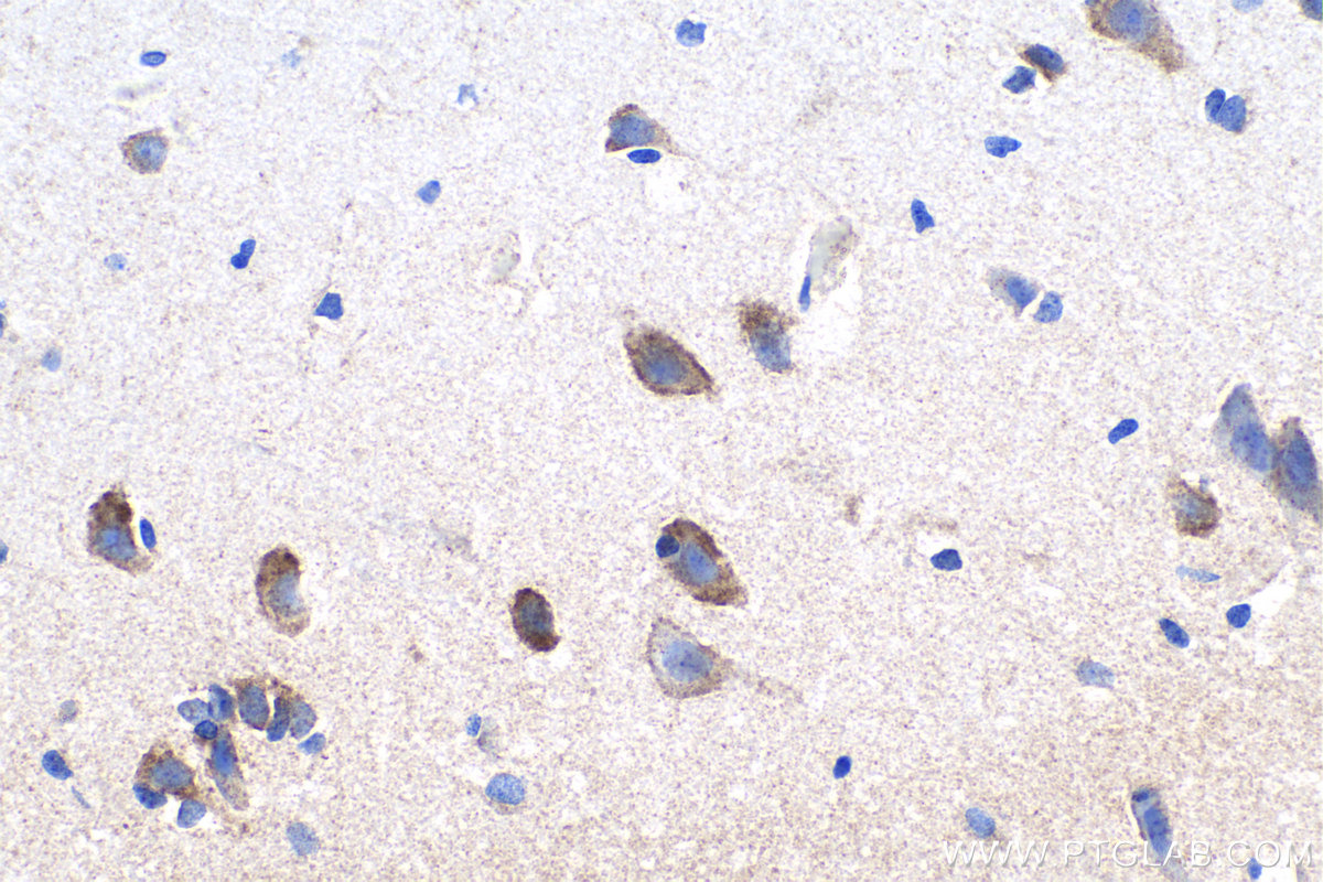IHC staining of human gliomas using 20070-1-AP