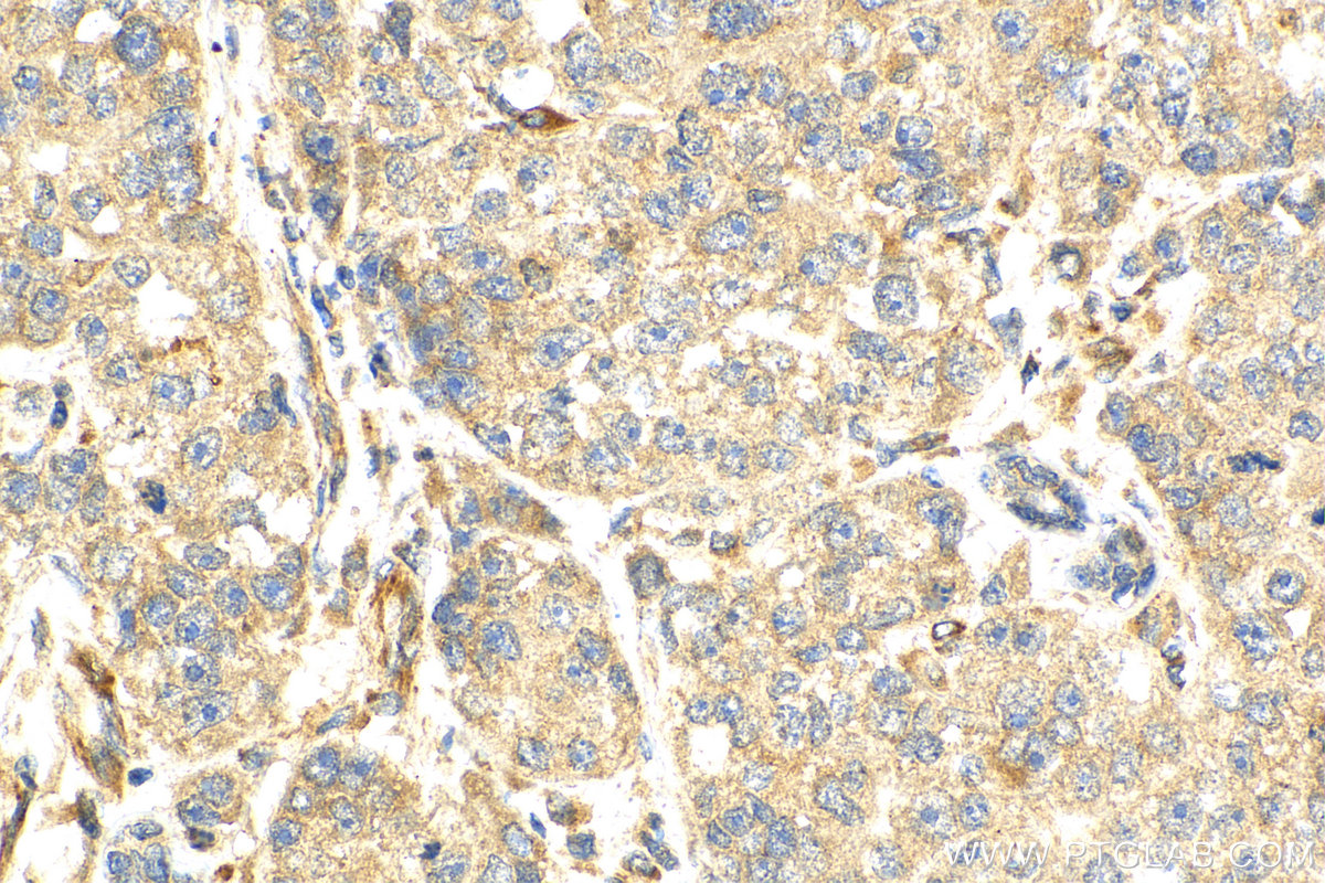 IHC staining of human breast cancer using 26638-1-AP