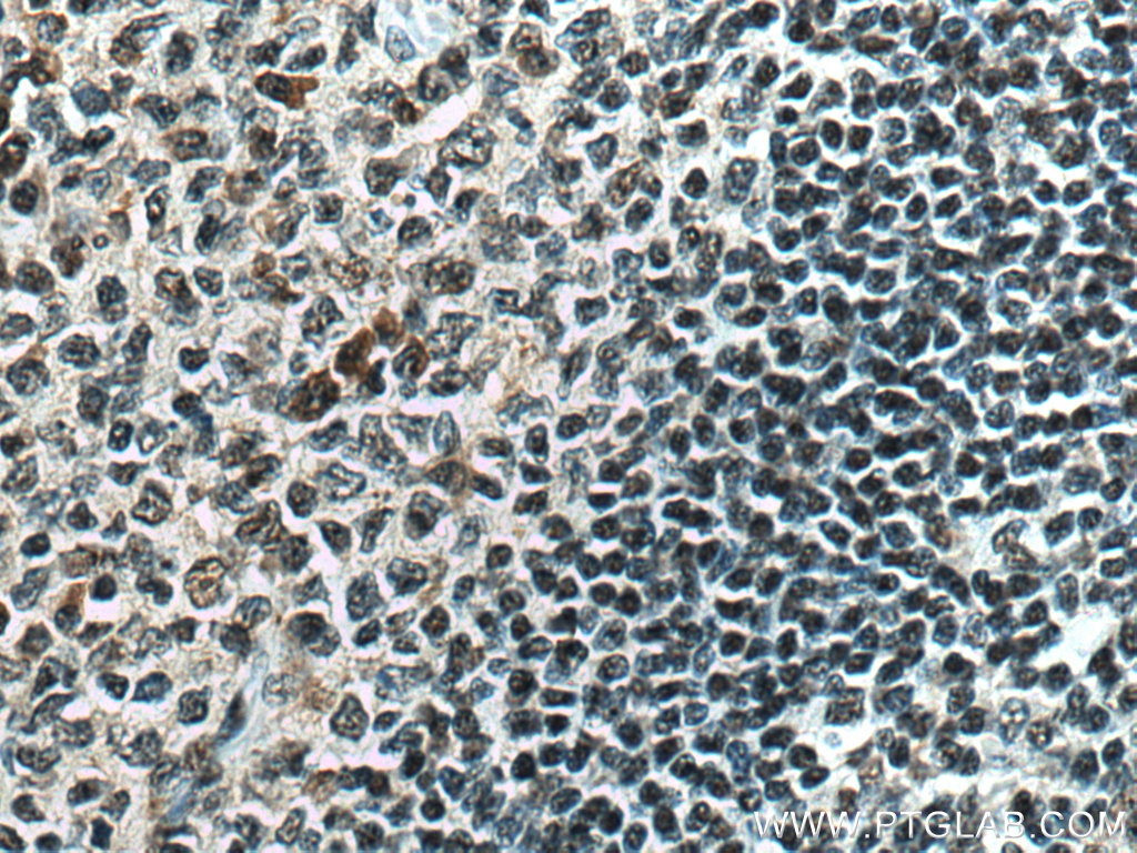 IHC staining of human tonsillitis using 16082-1-AP