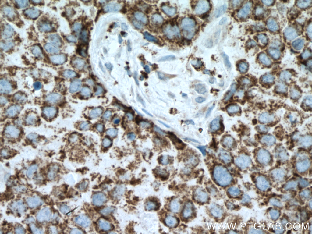 IHC staining of human breast cancer using 14892-1-AP