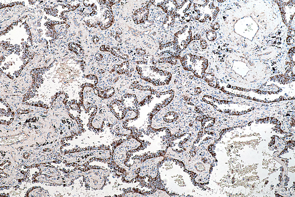 IHC staining of human lung cancer using 67676-1-Ig