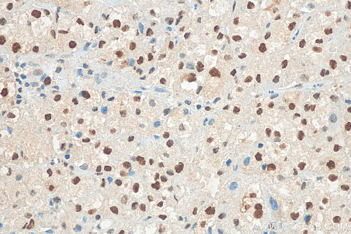 IHC staining of human liver cancer using 10205-2-AP