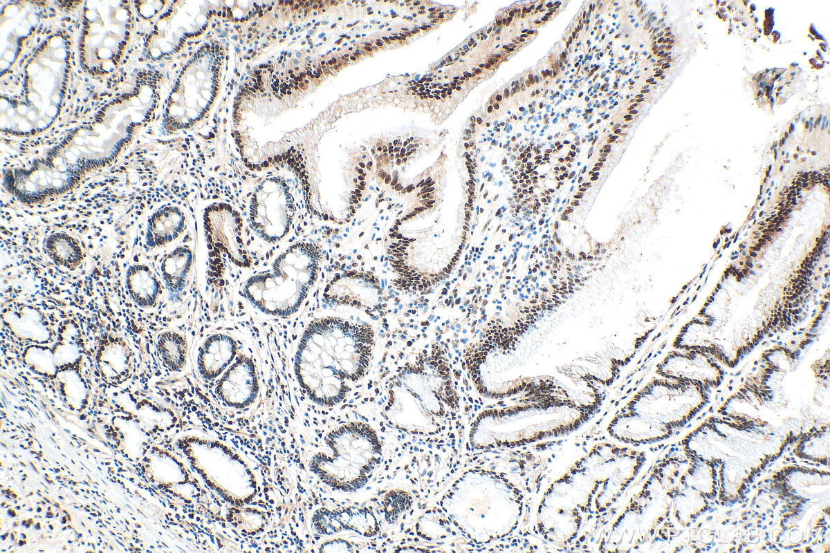 IHC staining of human stomach cancer using 10205-2-AP