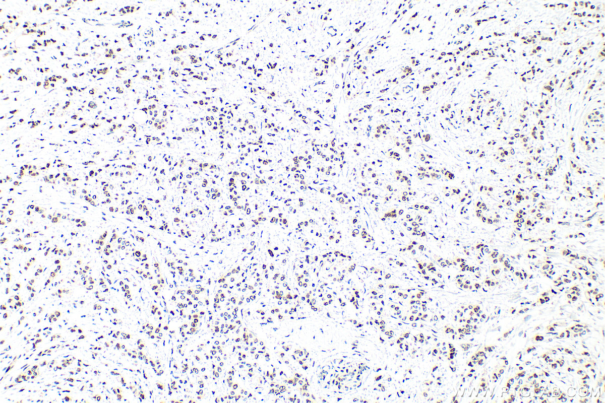 Immunohistochemical analysis of paraffin-embedded human breast cancer tissue slide using 10205-2-AP (PCNA antibody) at dilution of 1:6000 (under 10x lens). Heat mediated antigen retrieval with Tris-EDTA buffer (pH 9.0). IHC staining of human breast cancer using 10205-2-AP