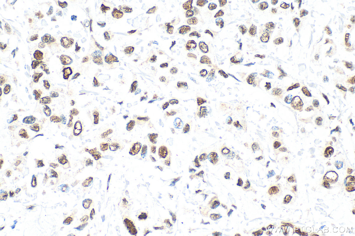 Immunohistochemical analysis of paraffin-embedded human breast cancer tissue slide using 10205-2-AP (PCNA antibody) at dilution of 1:6000 (under 40x lens). Heat mediated antigen retrieval with Tris-EDTA buffer (pH 9.0). IHC staining of human breast cancer using 10205-2-AP