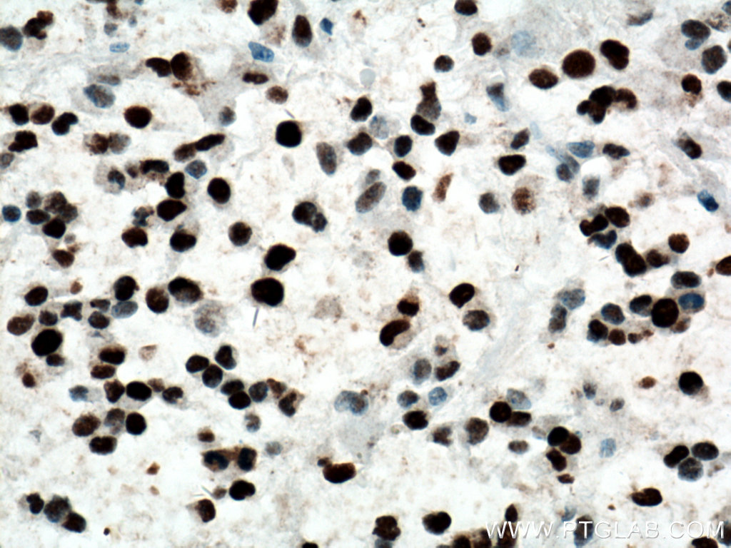 IHC staining of human gliomas using 24036-1-AP