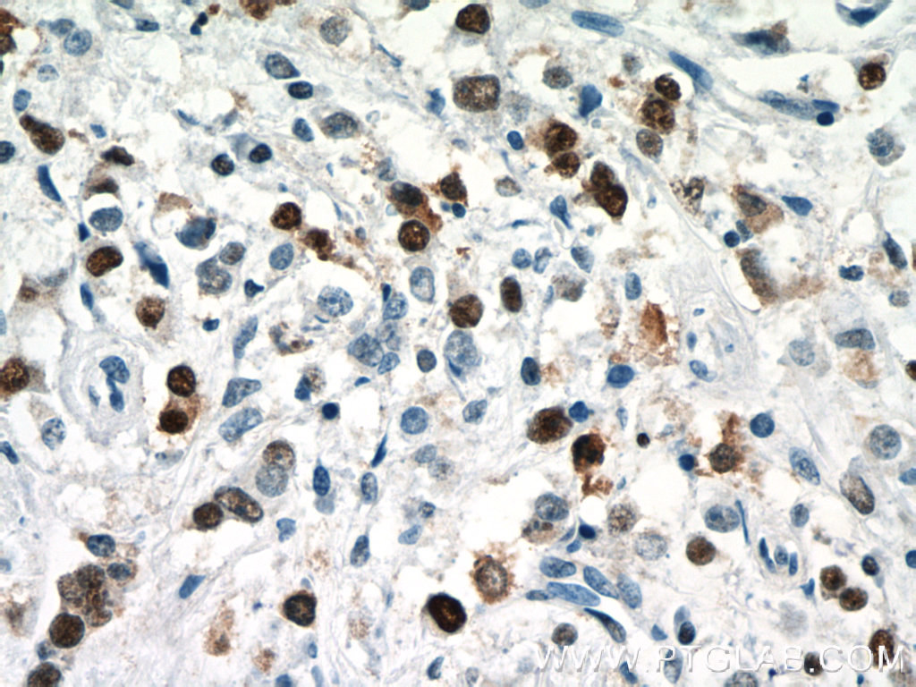 IHC staining of human breast cancer using 24036-1-AP