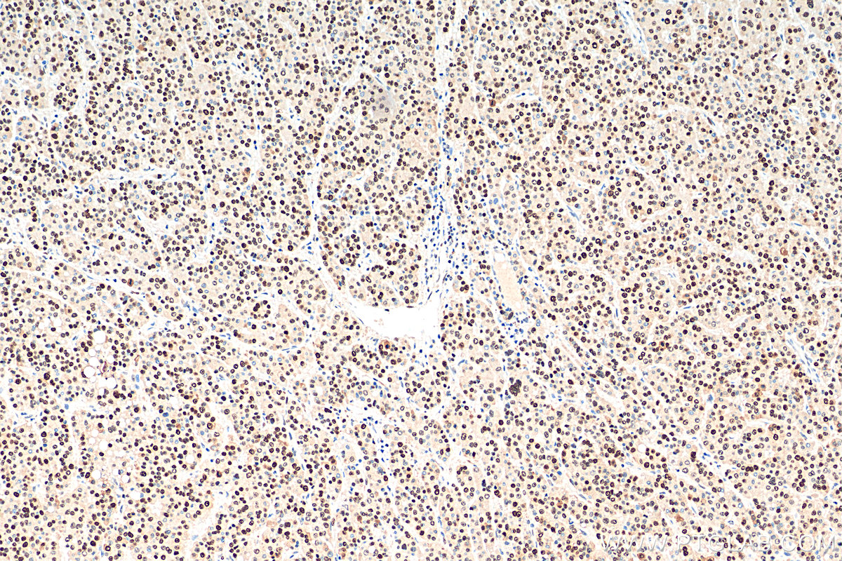 IHC staining of human liver cancer using 60097-1-Ig