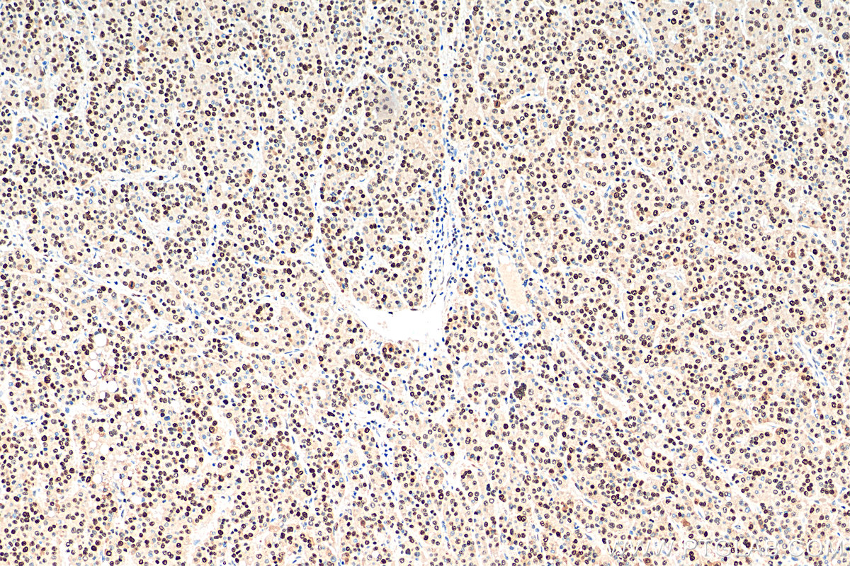 IHC staining of human liver cancer using 60097-1-Ig (same clone as 60097-1-PBS)