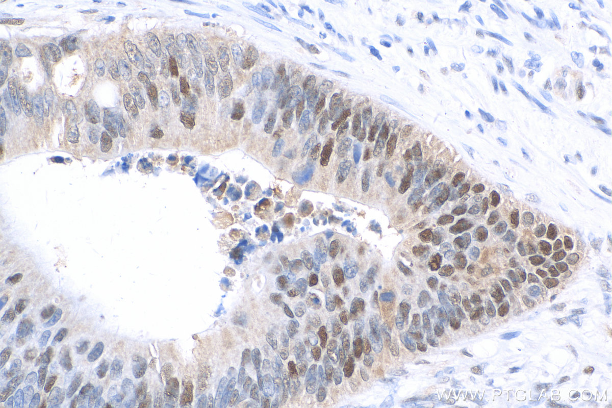 IHC staining of human colon cancer using Biotin-60097 IHC staining of human colon cancer using Biotin-60097