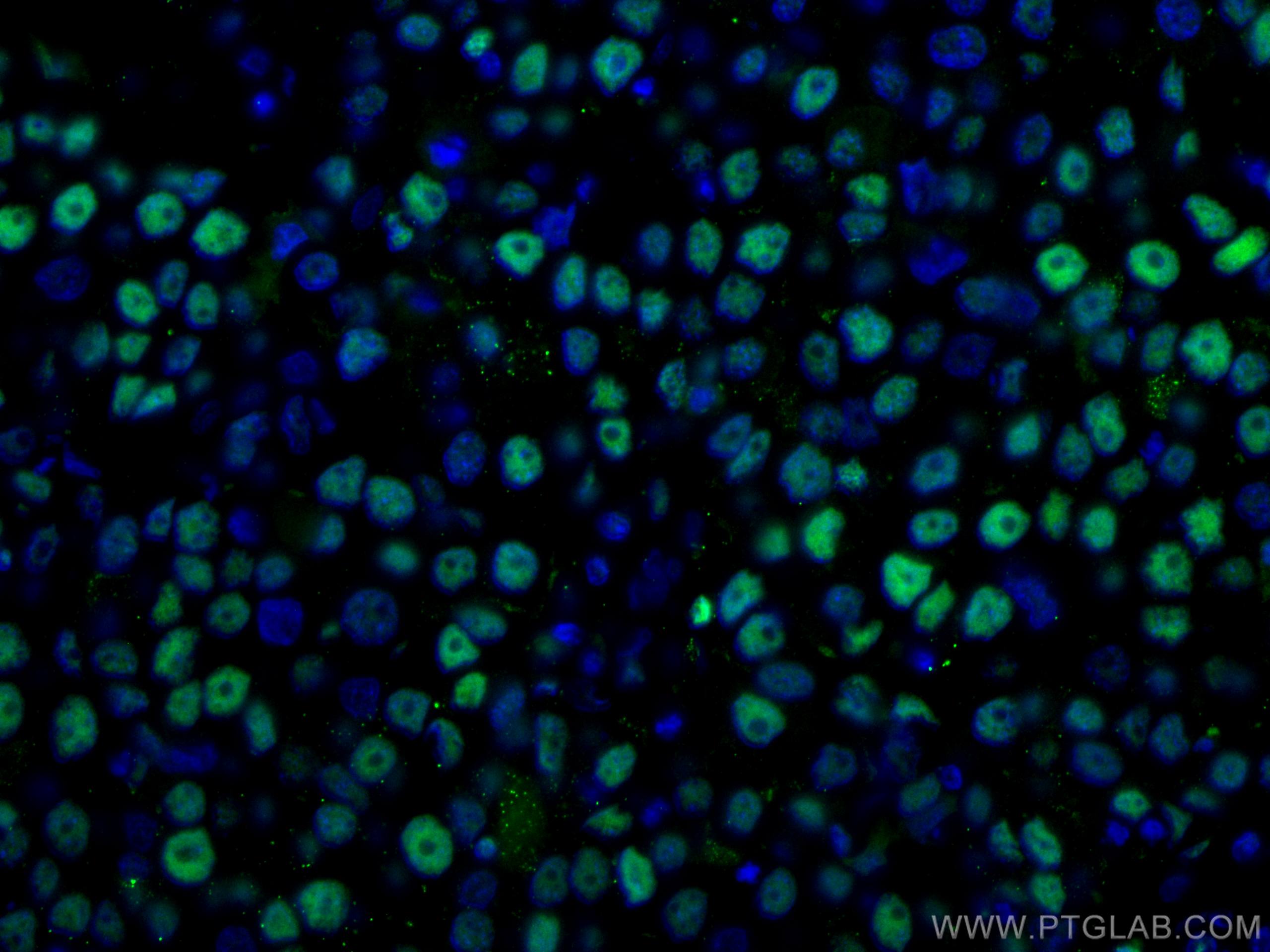 IF Staining of human breast cancer using CL488-10205
