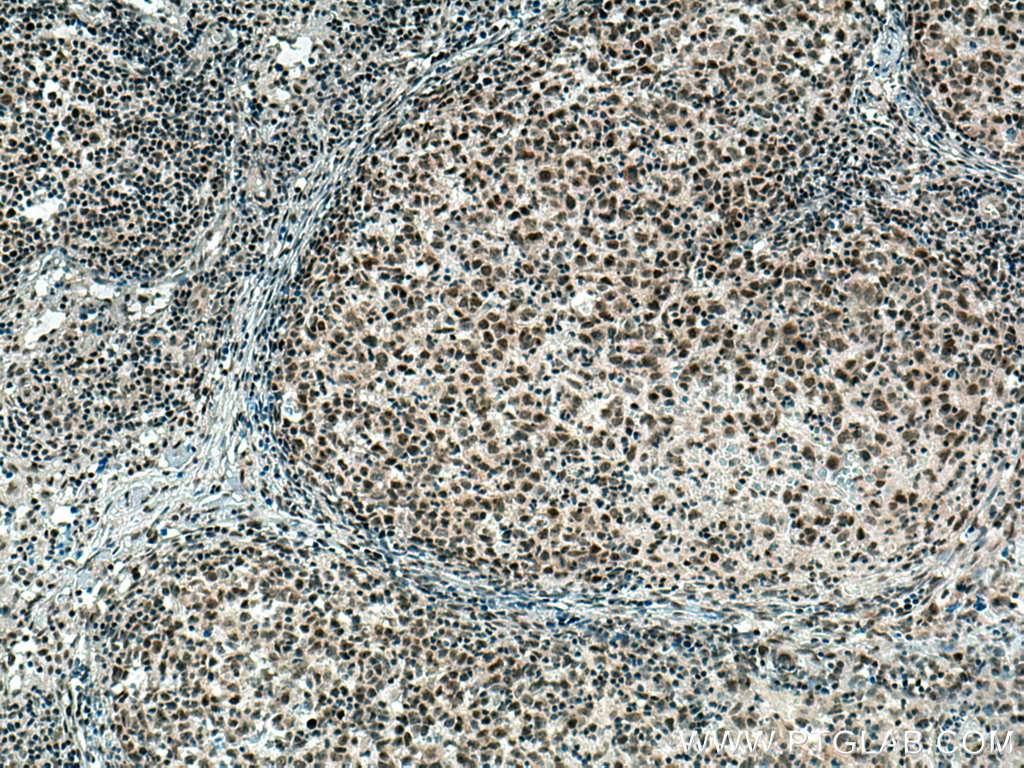 IHC staining of human lymphoma using 11180-2-AP