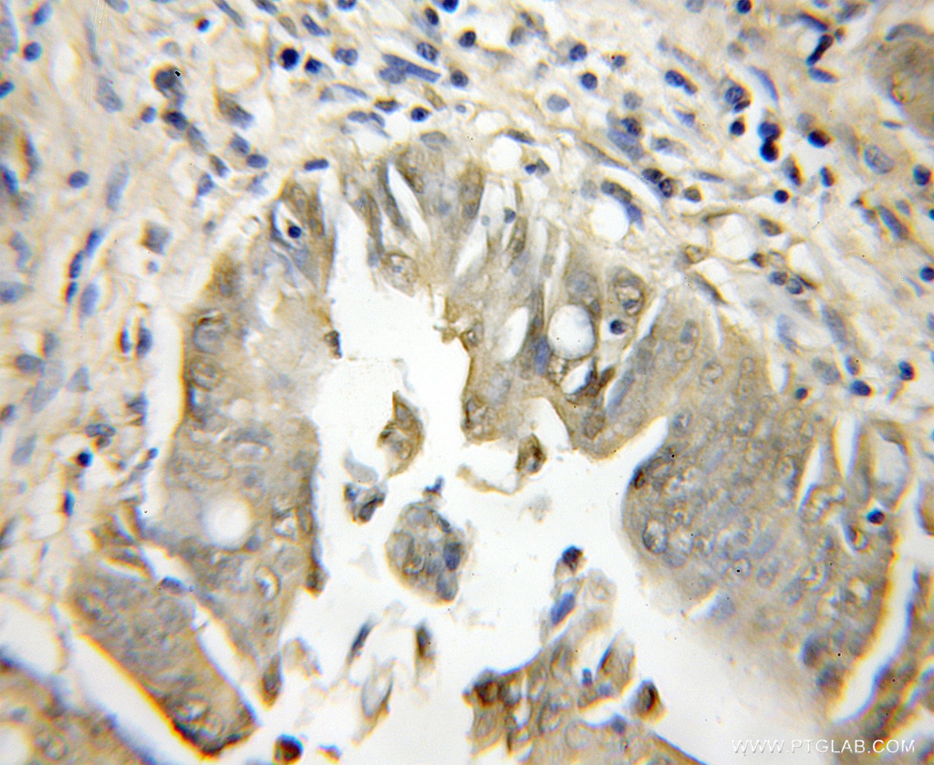 IHC staining of human colon cancer using 12044-1-AP