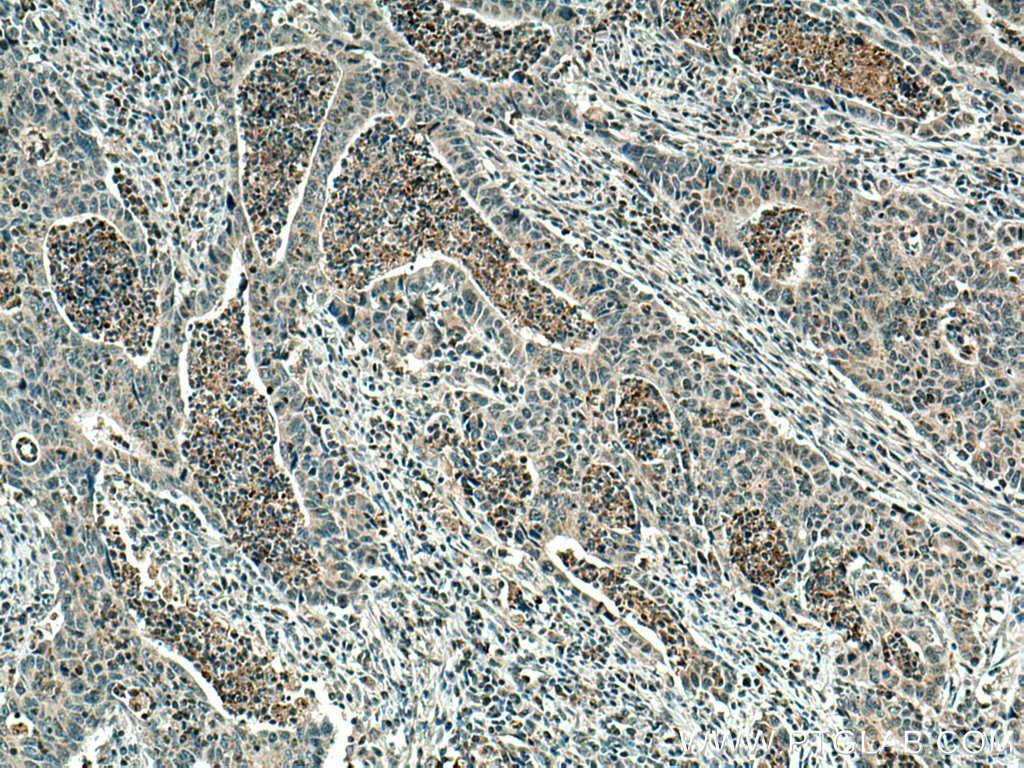 IHC staining of human colon cancer using 55206-1-AP