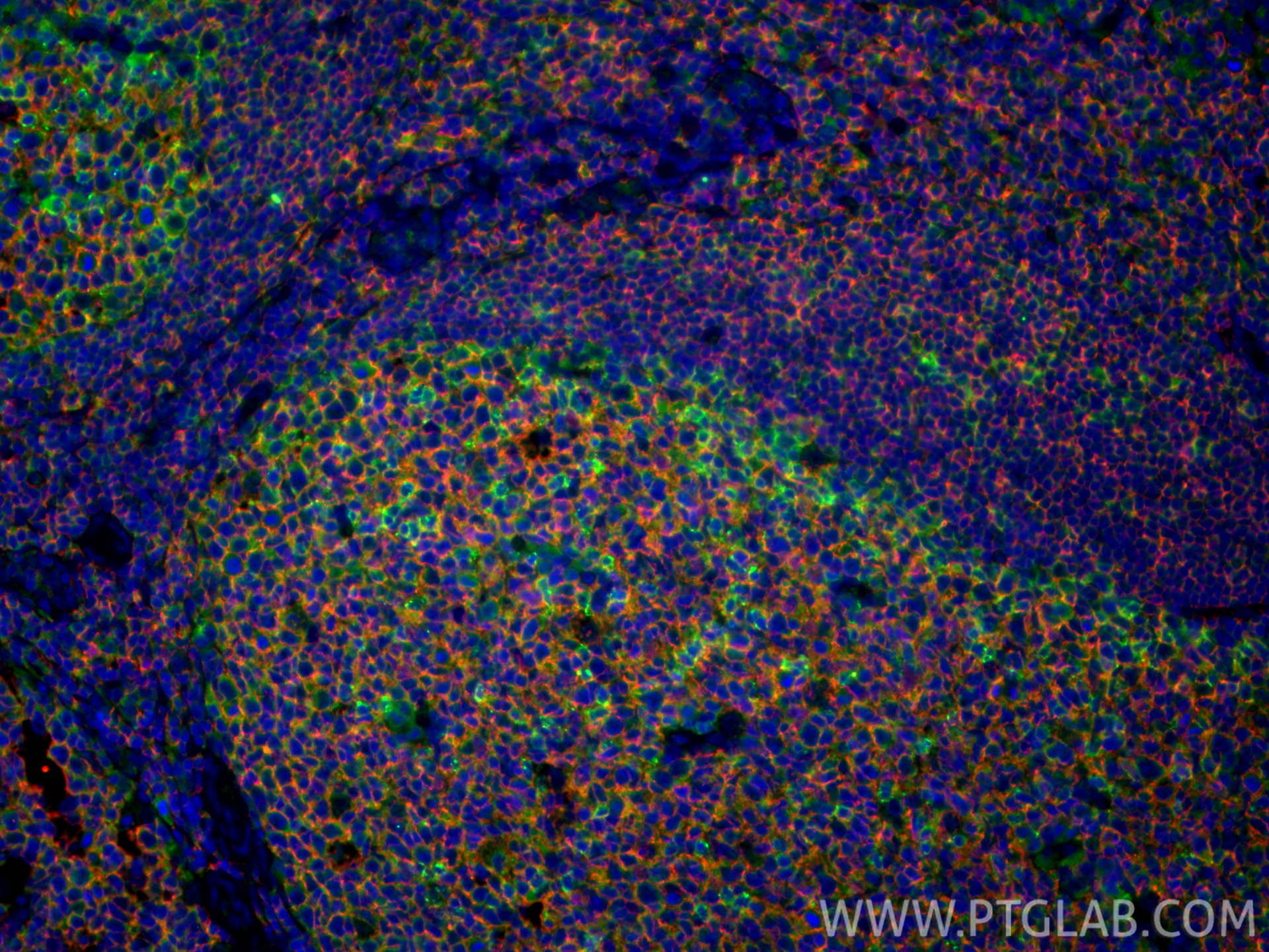 IF Staining of human tonsillitis using 31512-1-AP IF Staining of human tonsillitis using 31512-1-AP
