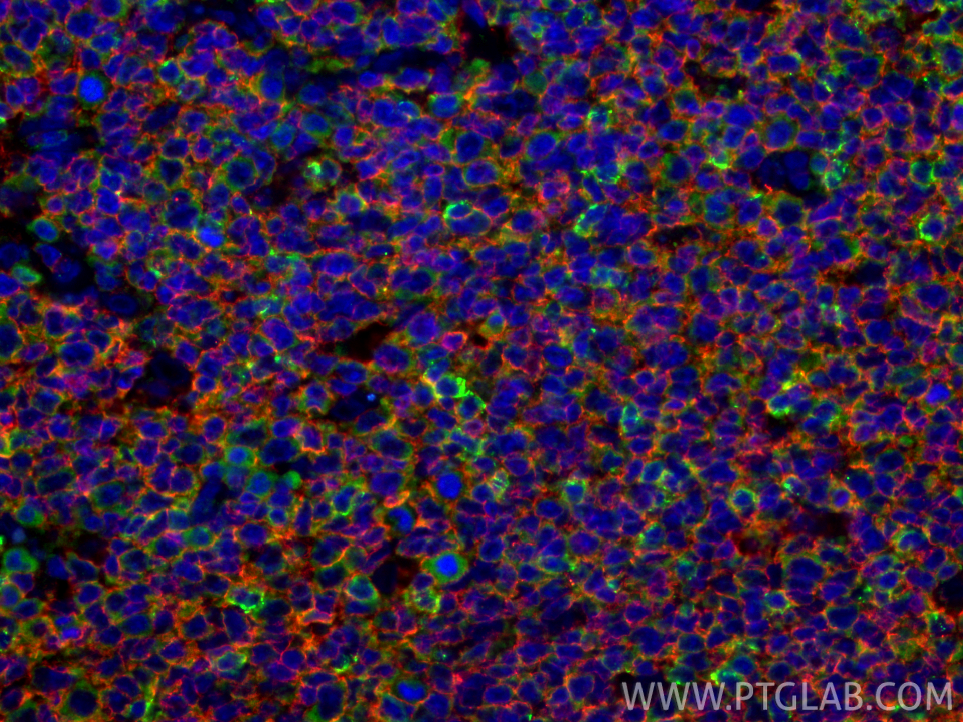 IF Staining of human tonsillitis using 31512-1-AP IF Staining of human tonsillitis using 31512-1-AP