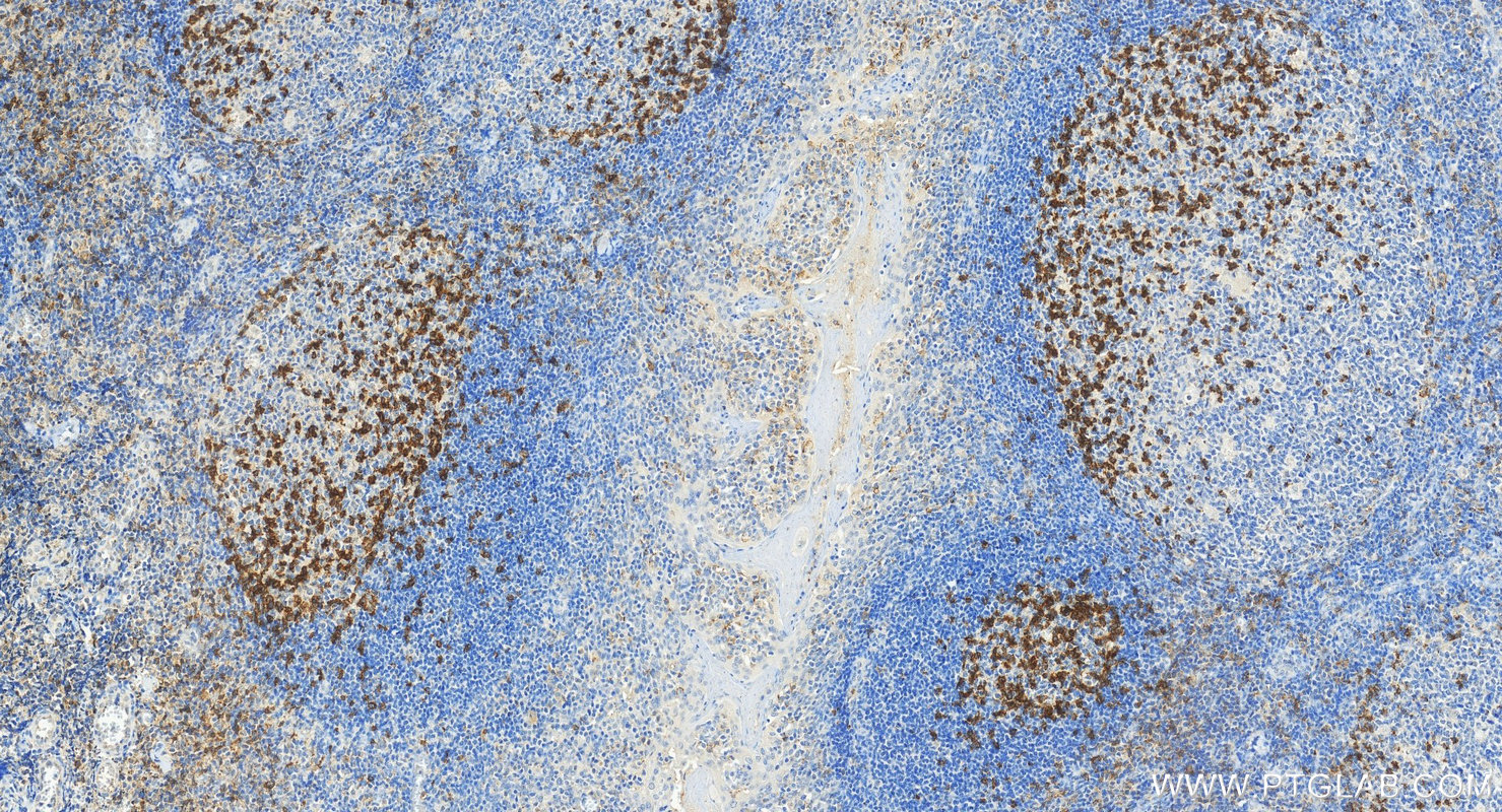 IHC staining of human tonsillitis using 31512-1-AP