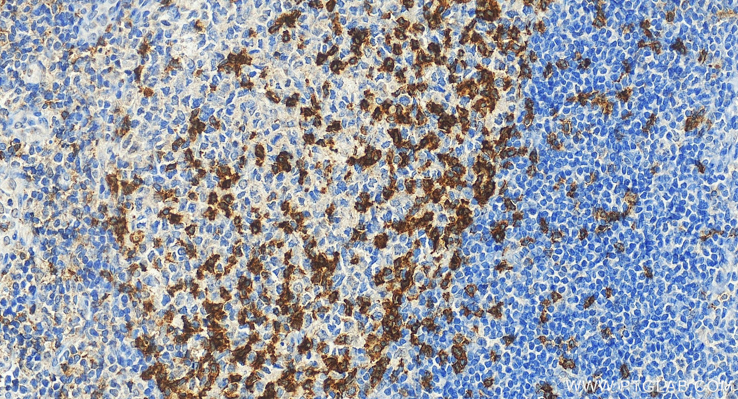 IHC staining of human tonsillitis using 31512-1-AP