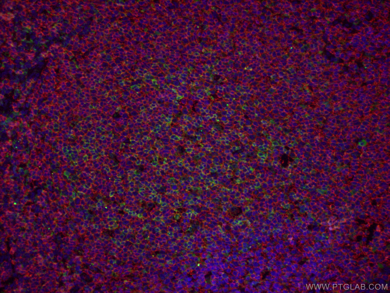 IF Staining of human tonsillitis using 66220-1-Ig (same clone as 66220-1-PBS)