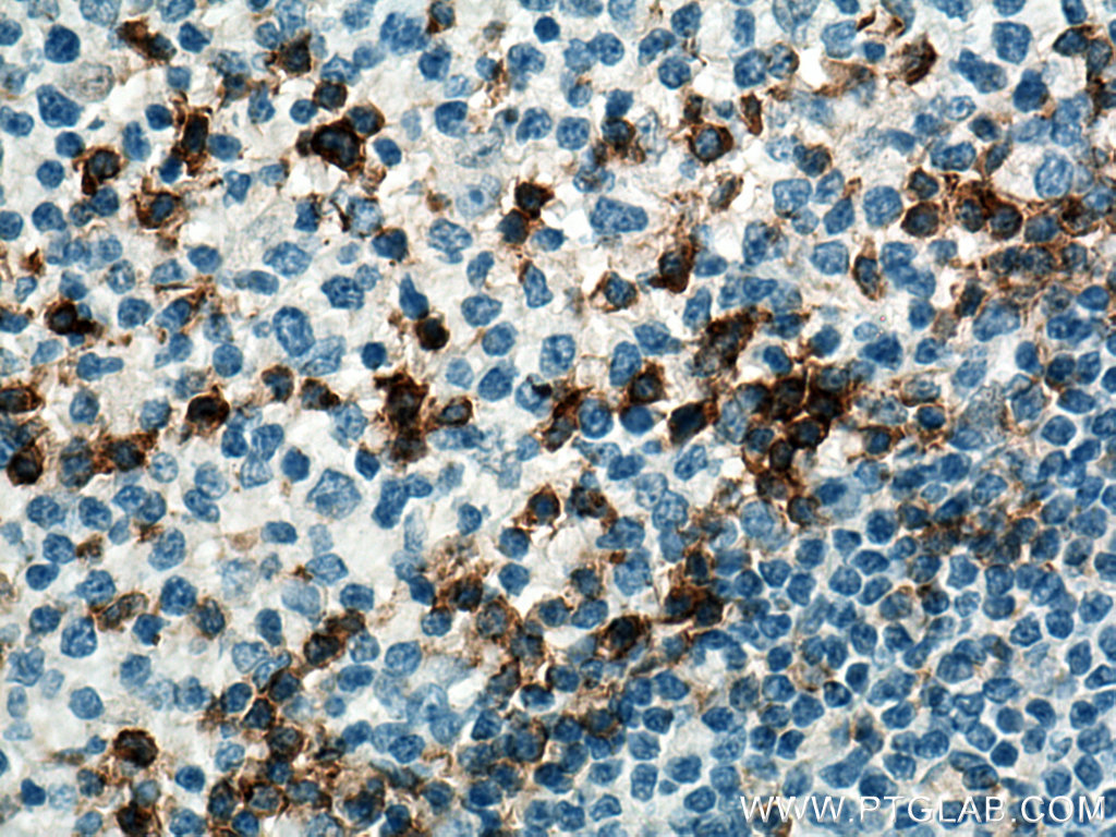 IHC staining of human tonsillitis using 66220-1-Ig (same clone as 66220-1-PBS)