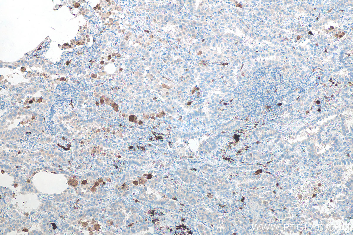 IHC staining of human lung cancer using 66220-1-Ig IHC staining of human lung cancer using 66220-1-Ig