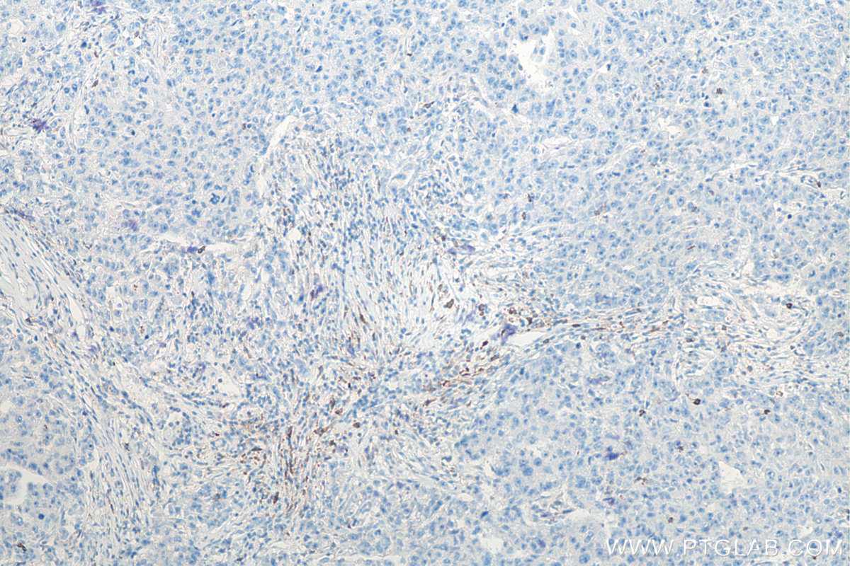 IHC staining of human breast cancer using 66220-1-Ig IHC staining of human breast cancer using 66220-1-Ig